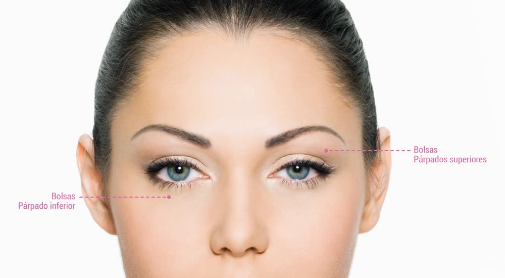 blefaroplastia simple