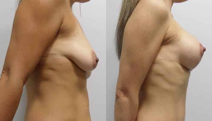 Antes y despues de aumento de pecho