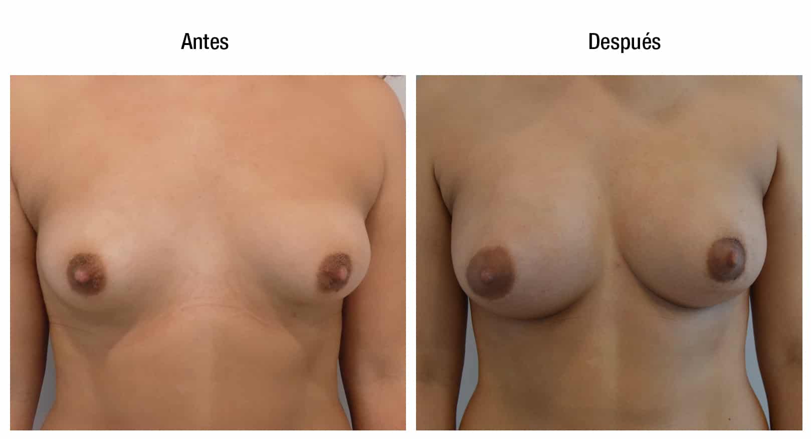 antes y despues aumento de senos cordoba