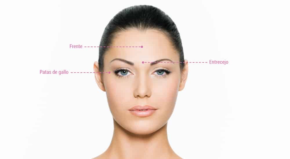botox puntos de aplicacion