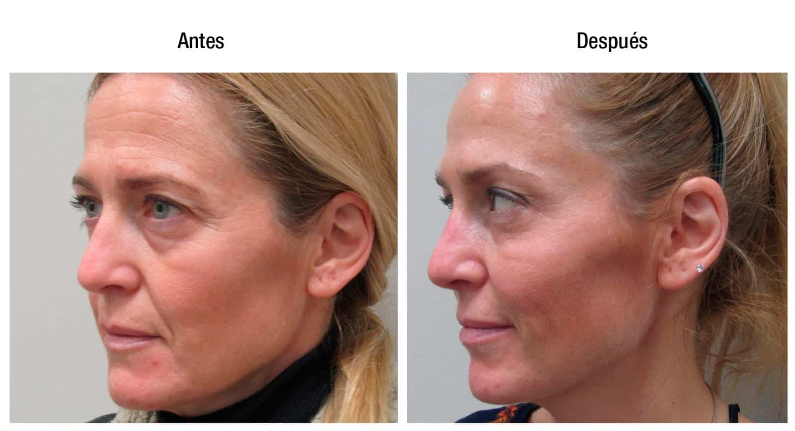 Antes y después contour lift