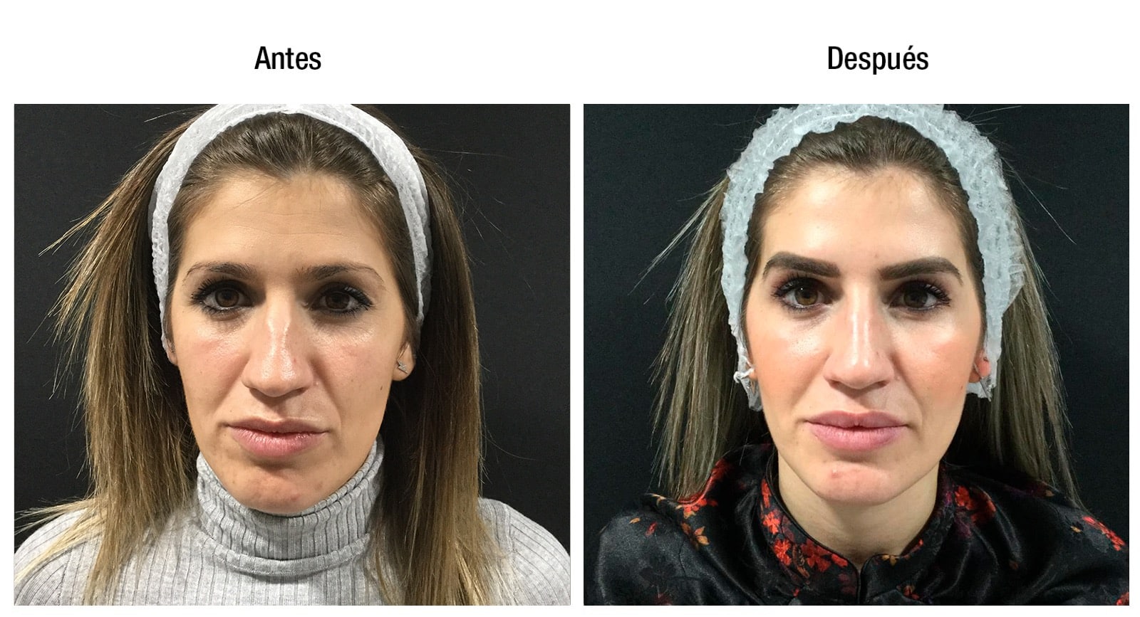 Antes y Después del tratamiento Hollywood Total Face