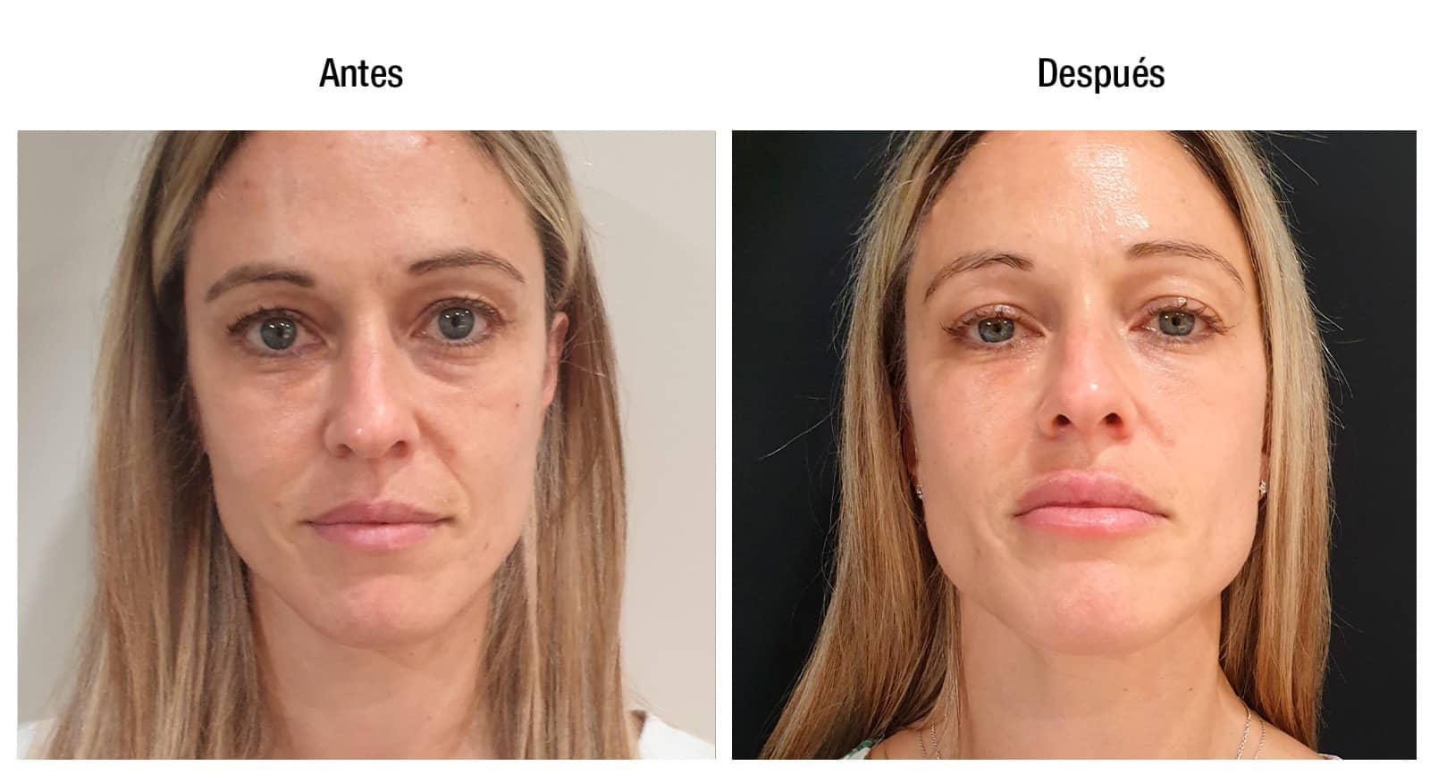 tratamiento facial dorsia resultados