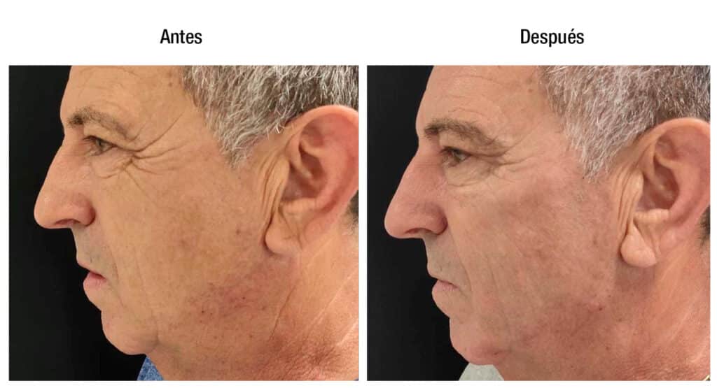 Paciente masculino de contour lift